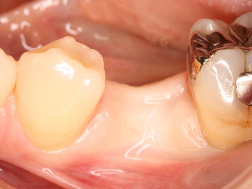 松本５　抜歯後4ヶ月半後